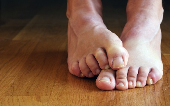 Szüntessük meg a lábdagadást!