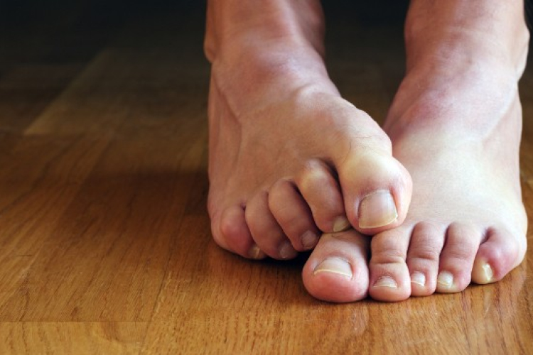 Szüntessük meg a lábdagadást!